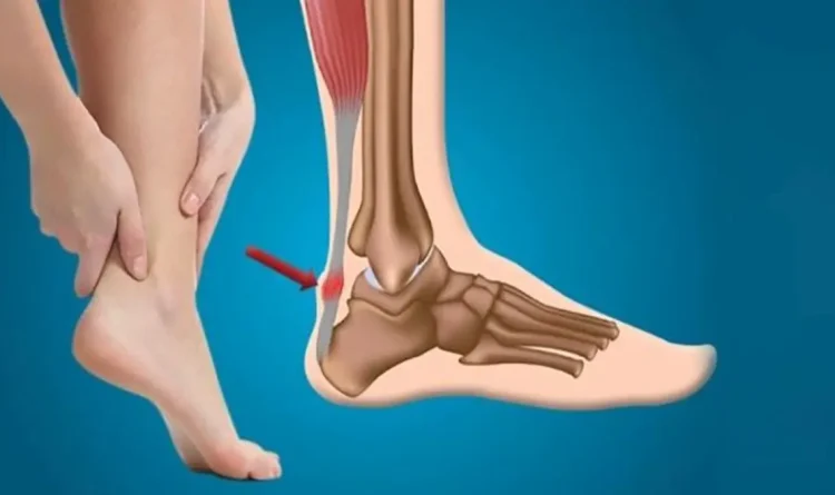 Achilles Tendonitis