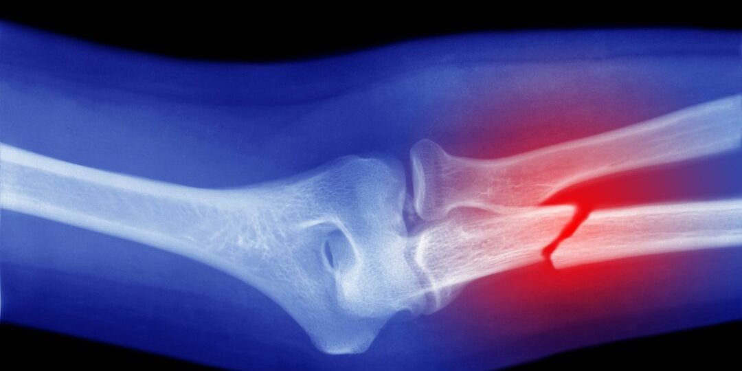 Broken Bones