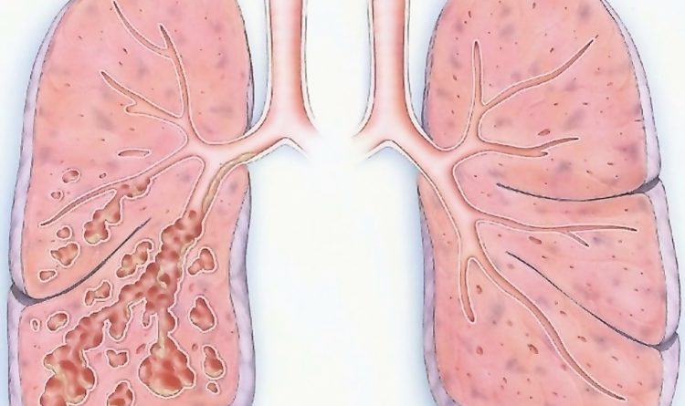 Bronchiectasis