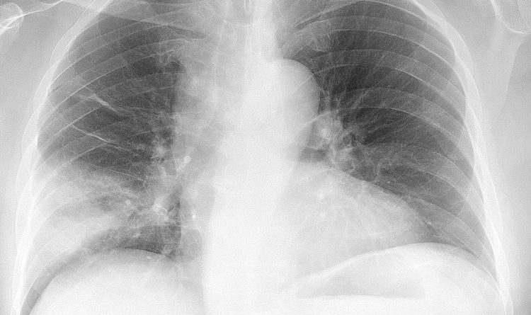 Chest Pneumonia