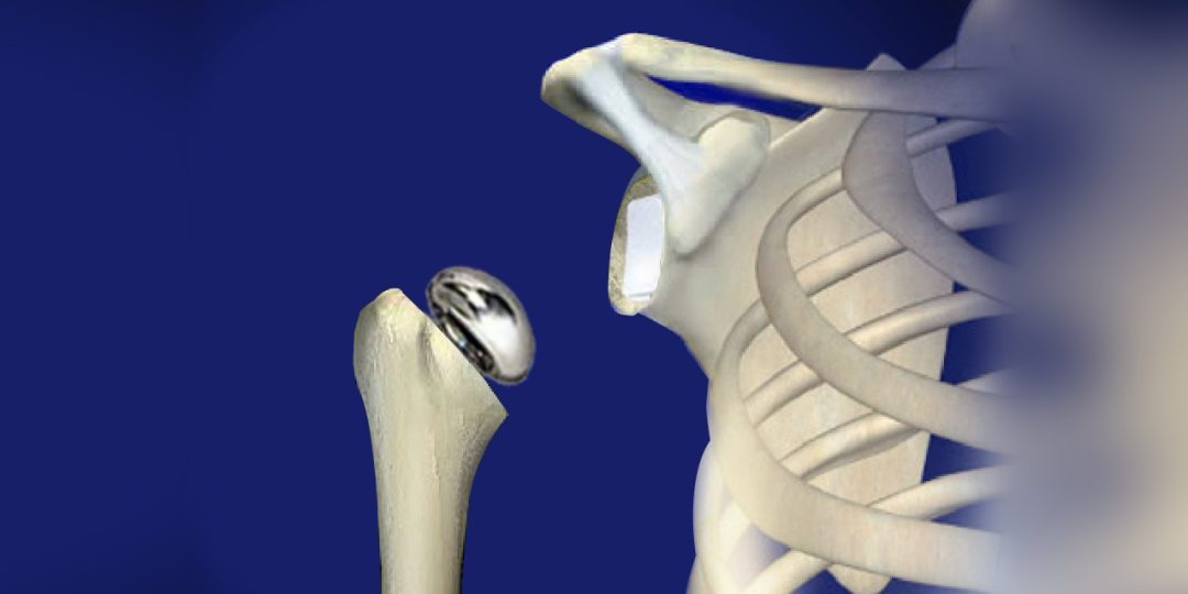 Hip, Knee, or Shoulder Replacement
