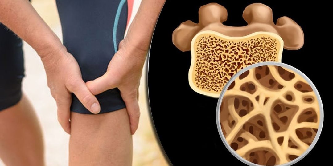 Osteoporosis