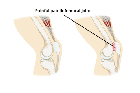Patellofemoral Syndrome