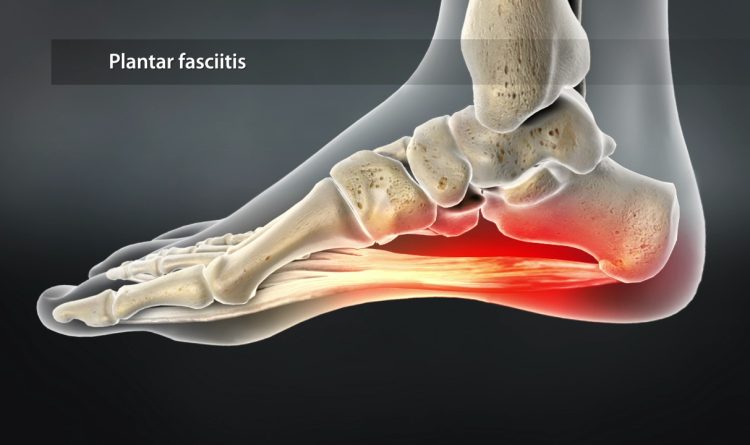 Plantar Fasciitis