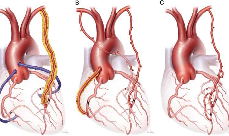 Rehabilitation for Post-CABG Patients
