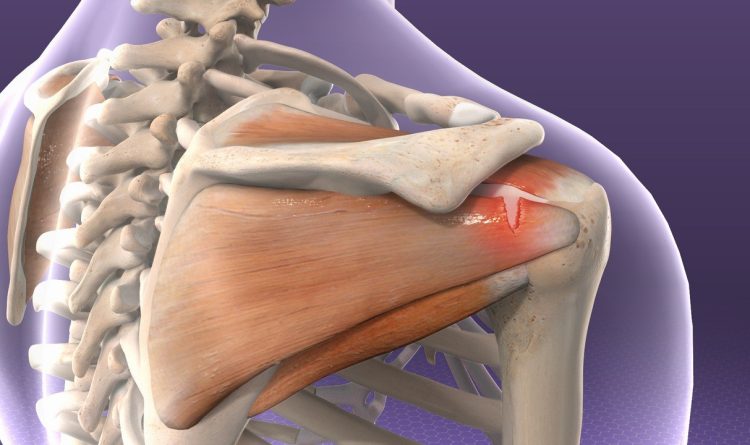 Rotator Cuff Injury