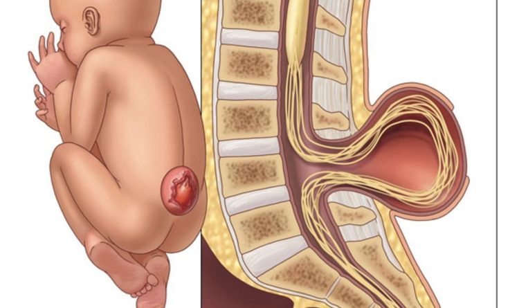 Spina Bifida