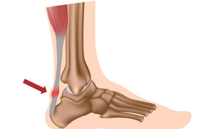 Tendinopathy