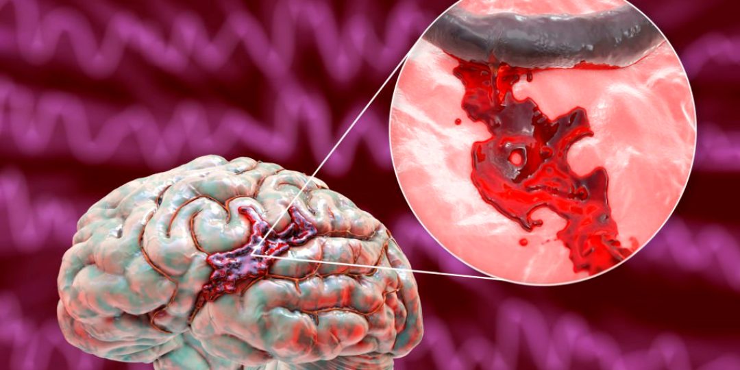hemorrhagic stroke